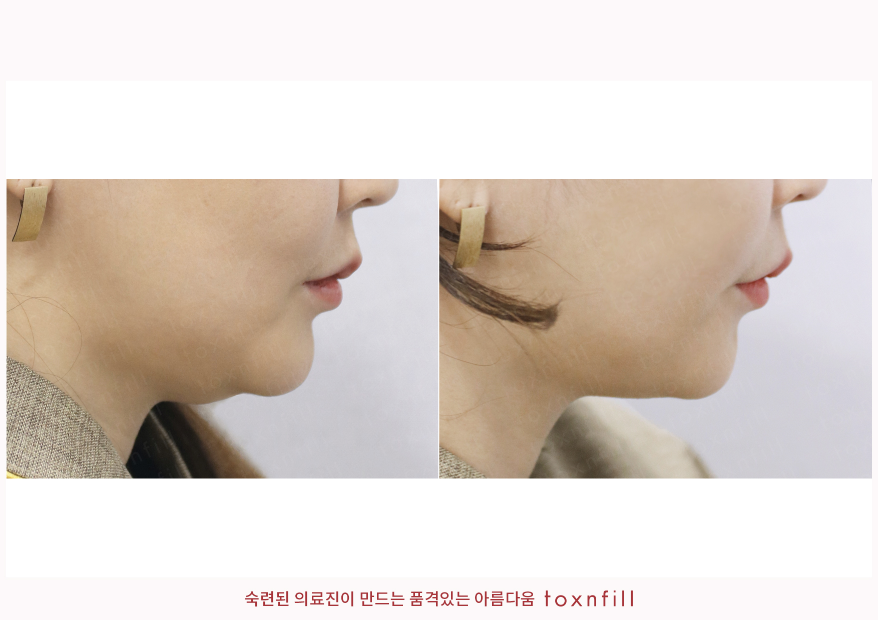 후기 2