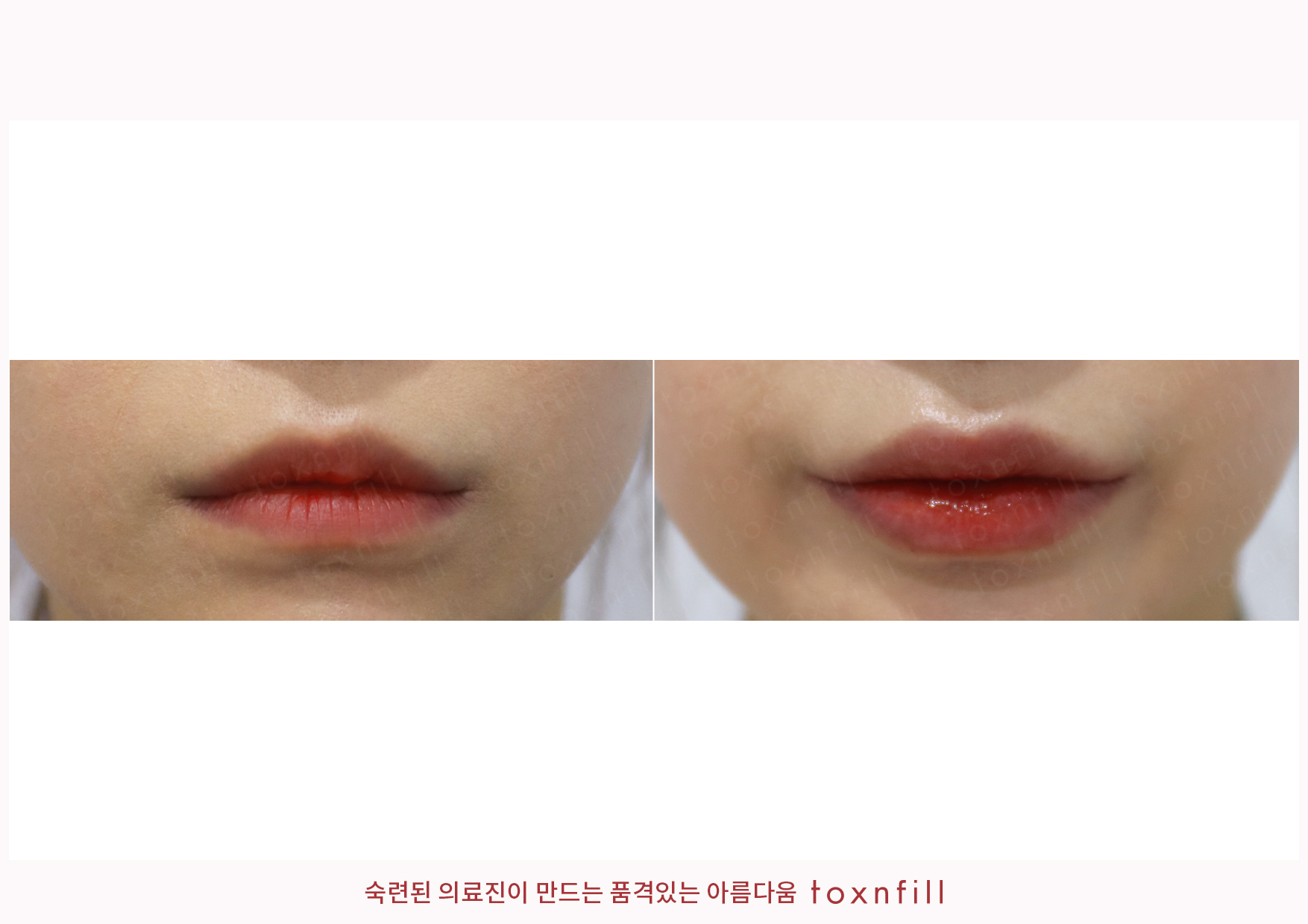 후기 5