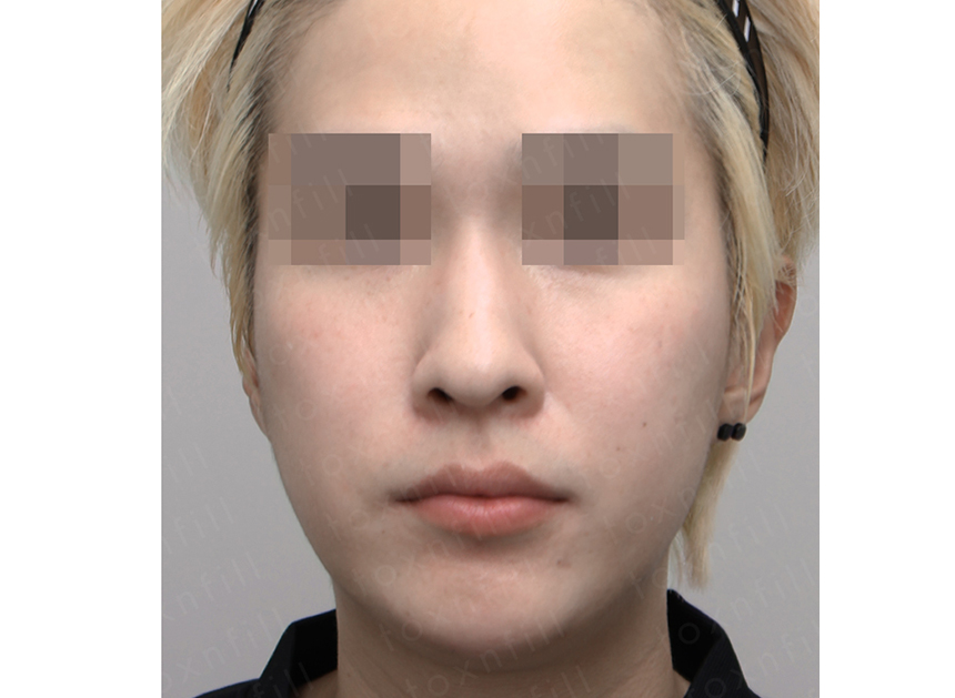 시술 후