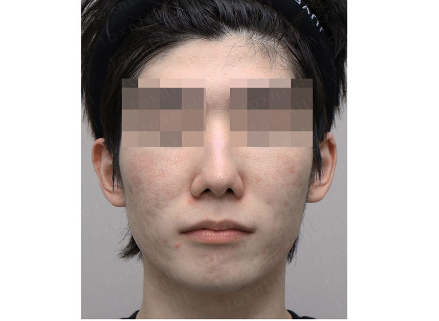 전후 썸네일 2