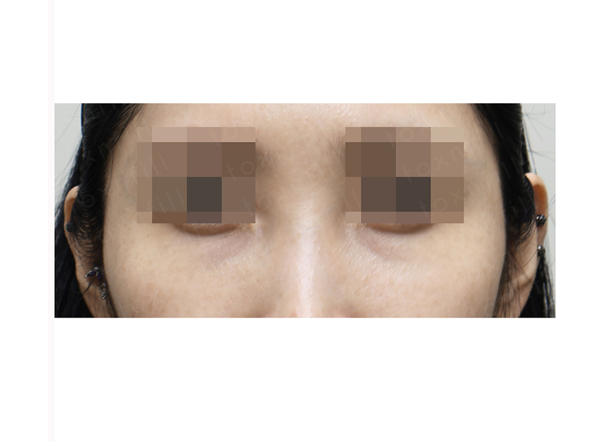 전후 썸네일 3